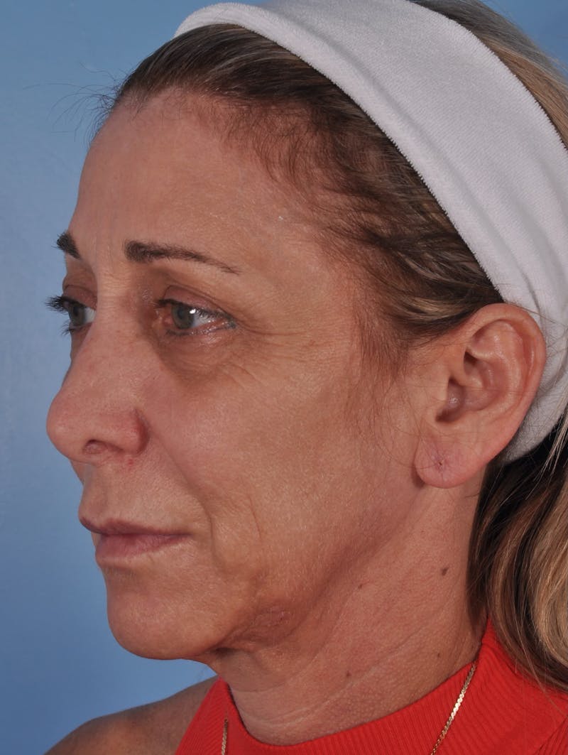 Lip Lift / Implants Before & After Gallery - Patient 616113 - Image 5