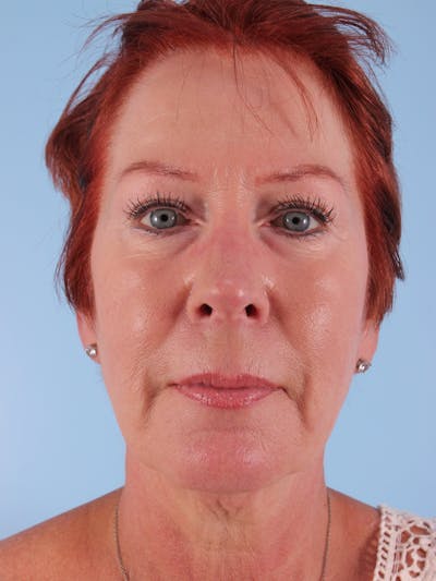 Facelift Before & After Gallery - Patient 357142 - Image 1