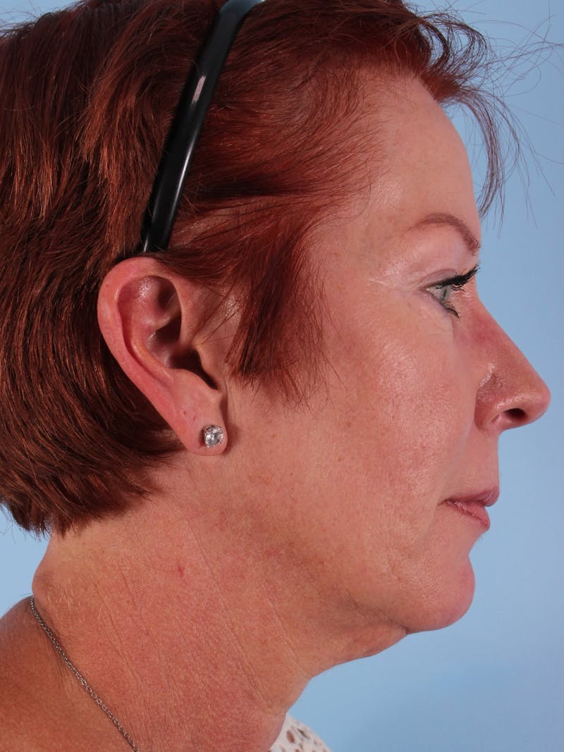 Facelift Before & After Gallery - Patient 357142 - Image 3