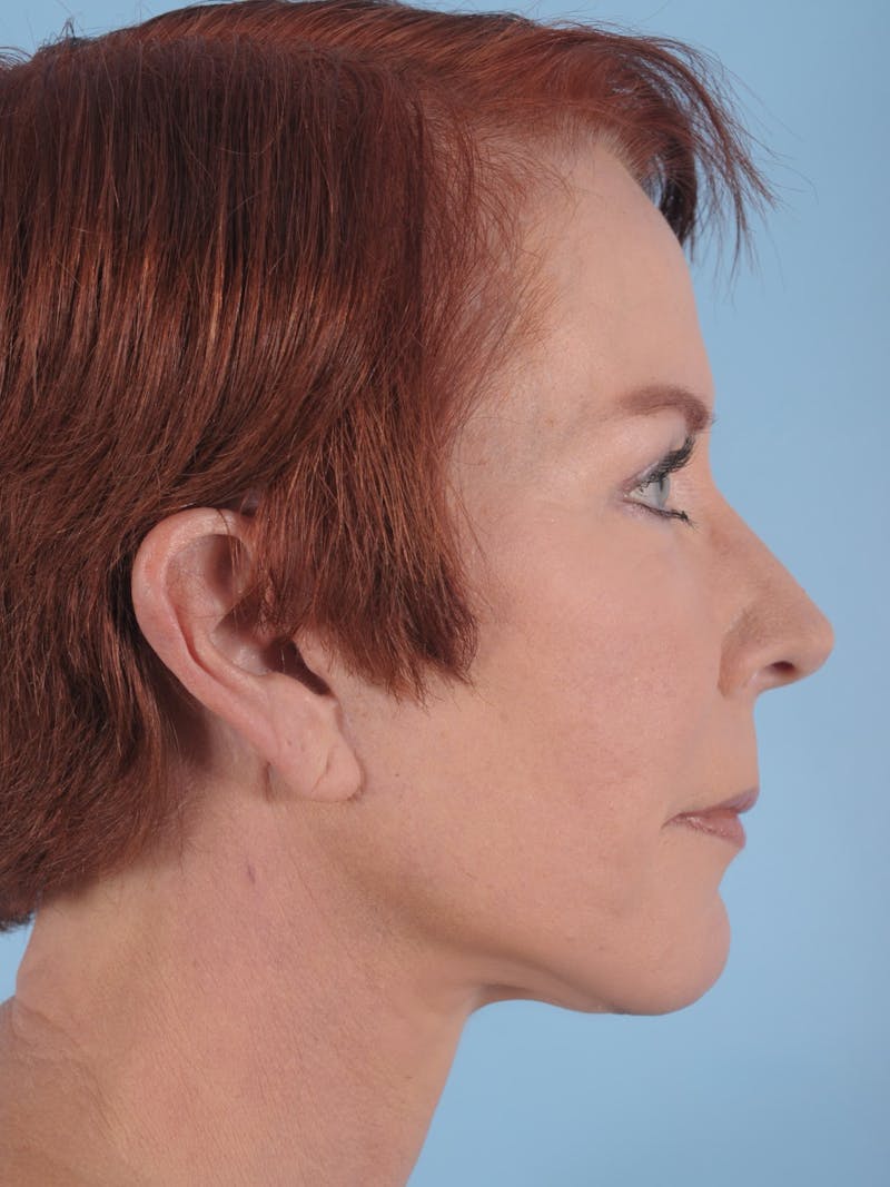 Facelift Before & After Gallery - Patient 357142 - Image 4