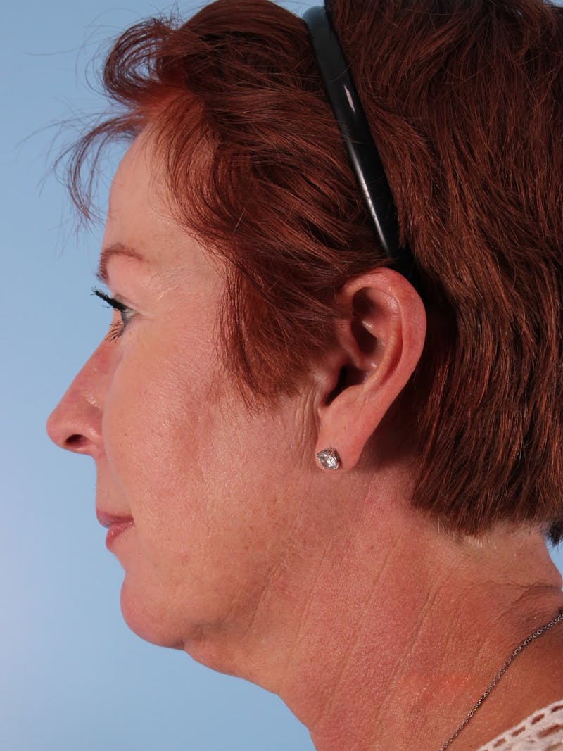 Facelift Before & After Gallery - Patient 357142 - Image 5