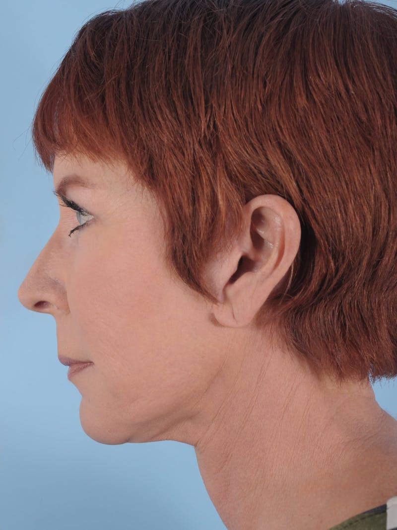 Facelift Before & After Gallery - Patient 357142 - Image 6