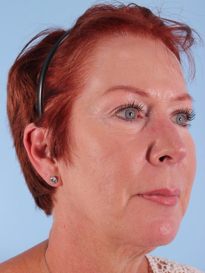 Facial Resurfacing Before & After Gallery - Patient 929926 - Image 7