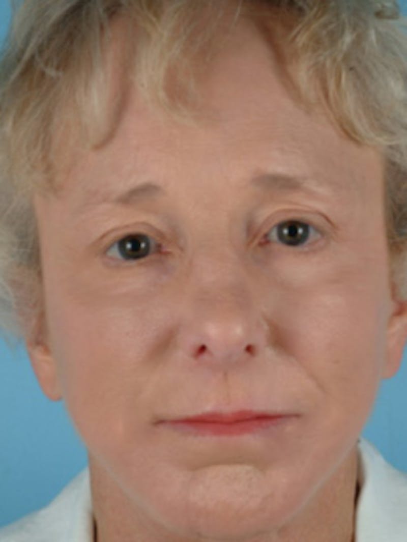 Facelift Before & After Gallery - Patient 251233 - Image 2