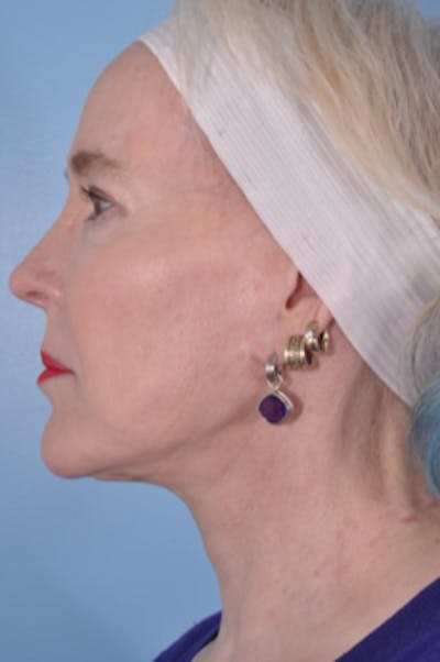 Facial Resurfacing Before & After Gallery - Patient 107436 - Image 2
