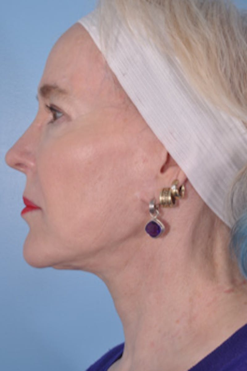 Facial Resurfacing Before & After Gallery - Patient 107436 - Image 2