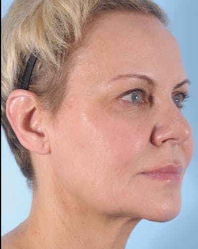 Ultherapy Before & After Gallery - Patient 417383 - Image 1