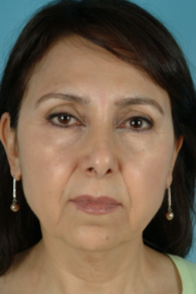 Facelift Surgery  Before & After Gallery - Patient 289412 - Image 1