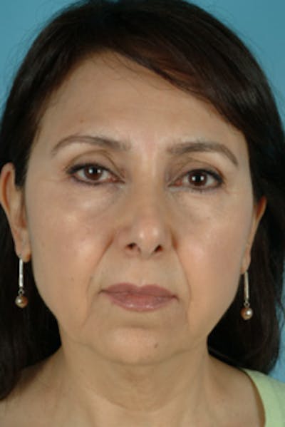 Facelift Before & After Gallery - Patient 289412 - Image 1