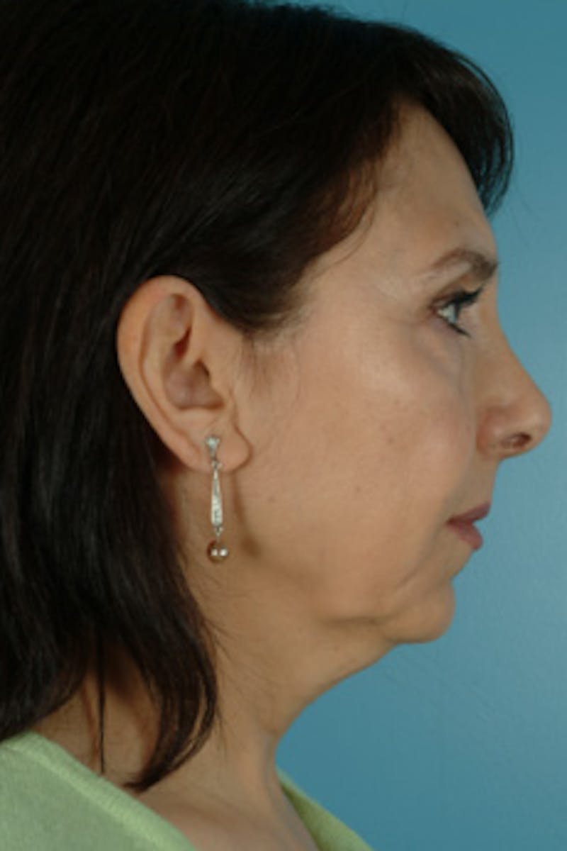 Facelift Surgery  Before & After Gallery - Patient 289412 - Image 3