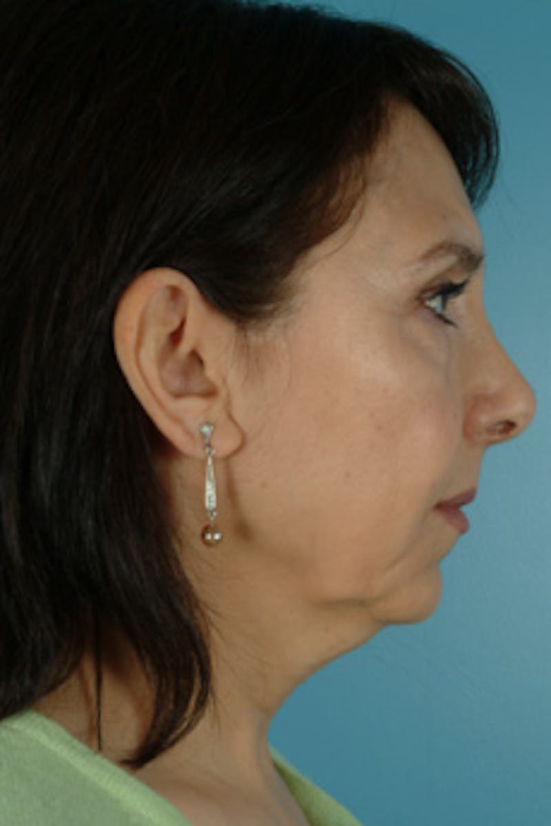 Facelift Before & After Gallery - Patient 289412 - Image 3