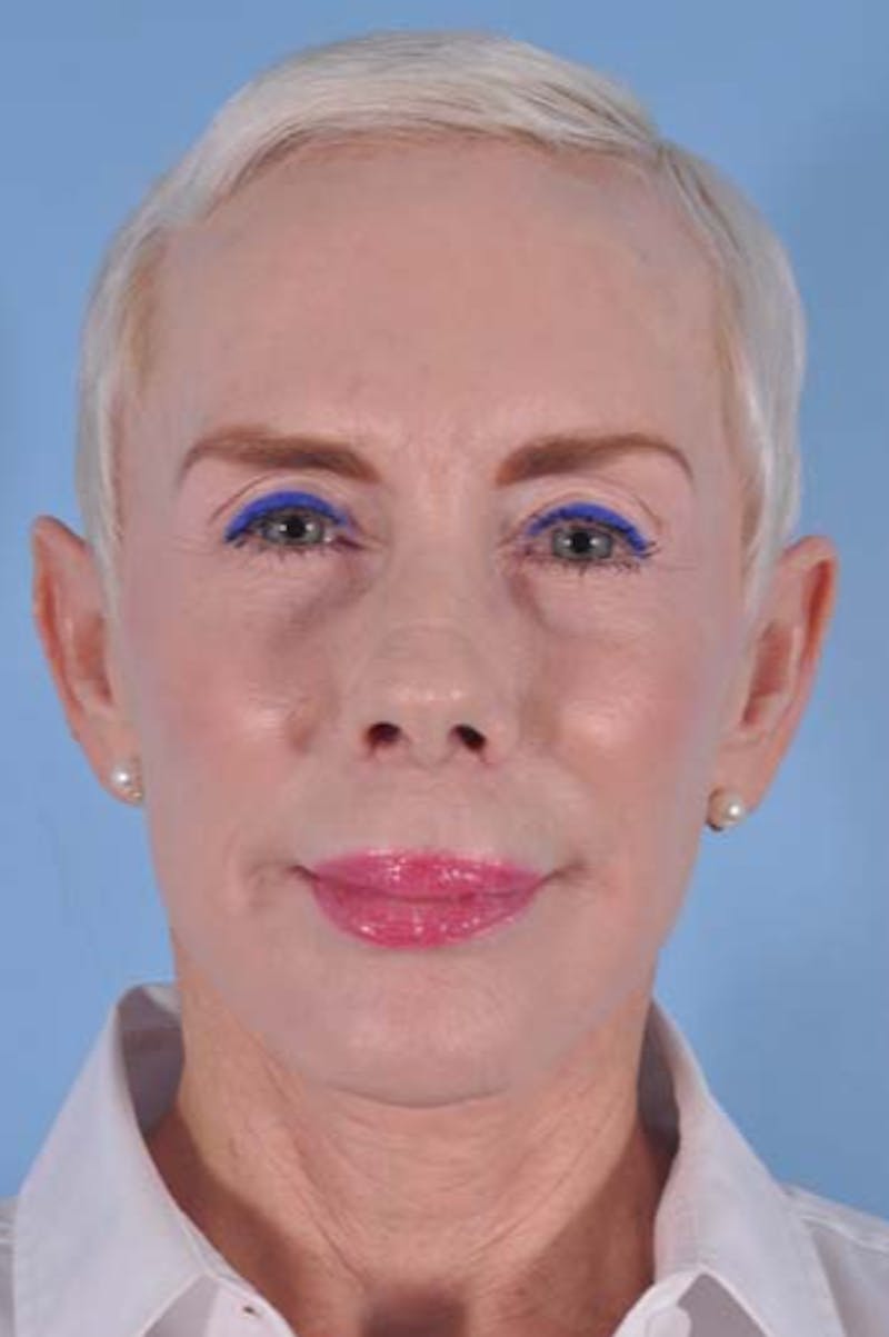 Facelift Before & After Gallery - Patient 122977 - Image 1