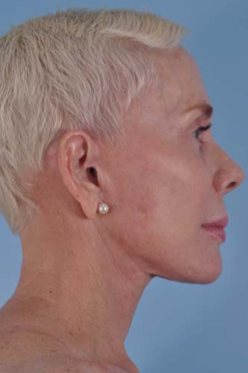 Facelift Before & After Gallery - Patient 122977 - Image 8