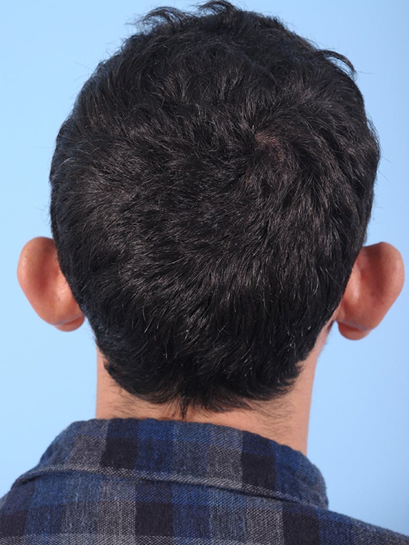 Otoplasty (Ear Surgery) Before & After Gallery - Patient 453670 - Image 3