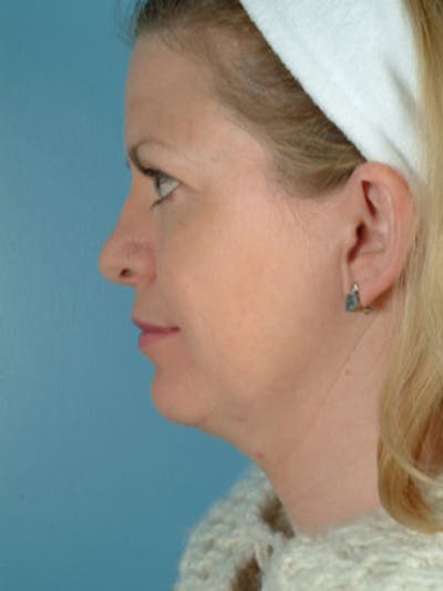 Facelift Before & After Gallery - Patient 208016 - Image 1
