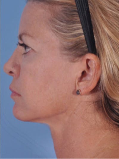 Neck Lift Before & After Gallery - Patient 352034 - Image 2