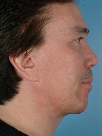 Chin Implant Before & After Gallery - Patient 124053 - Image 2