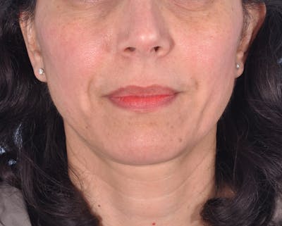 IPL Photofacial Before & After Gallery - Patient 421212 - Image 1
