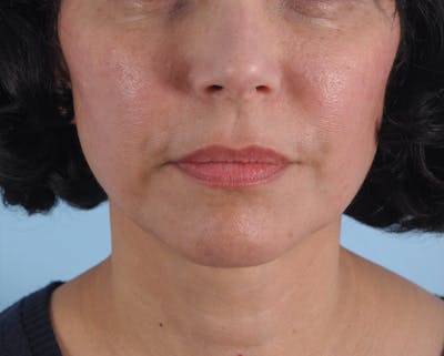 IPL Photofacial Before & After Gallery - Patient 421212 - Image 2