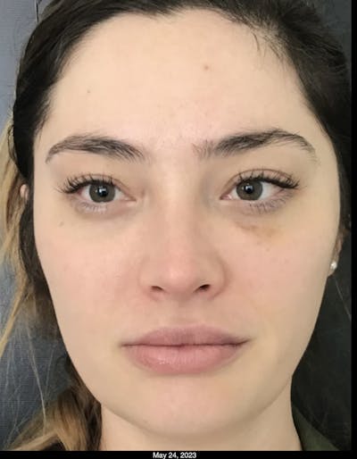 Dermal Fillers Before & After Gallery - Patient 307118 - Image 2