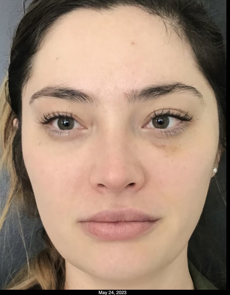 Dermal Fillers Before & After Gallery - Patient 307118 - Image 2