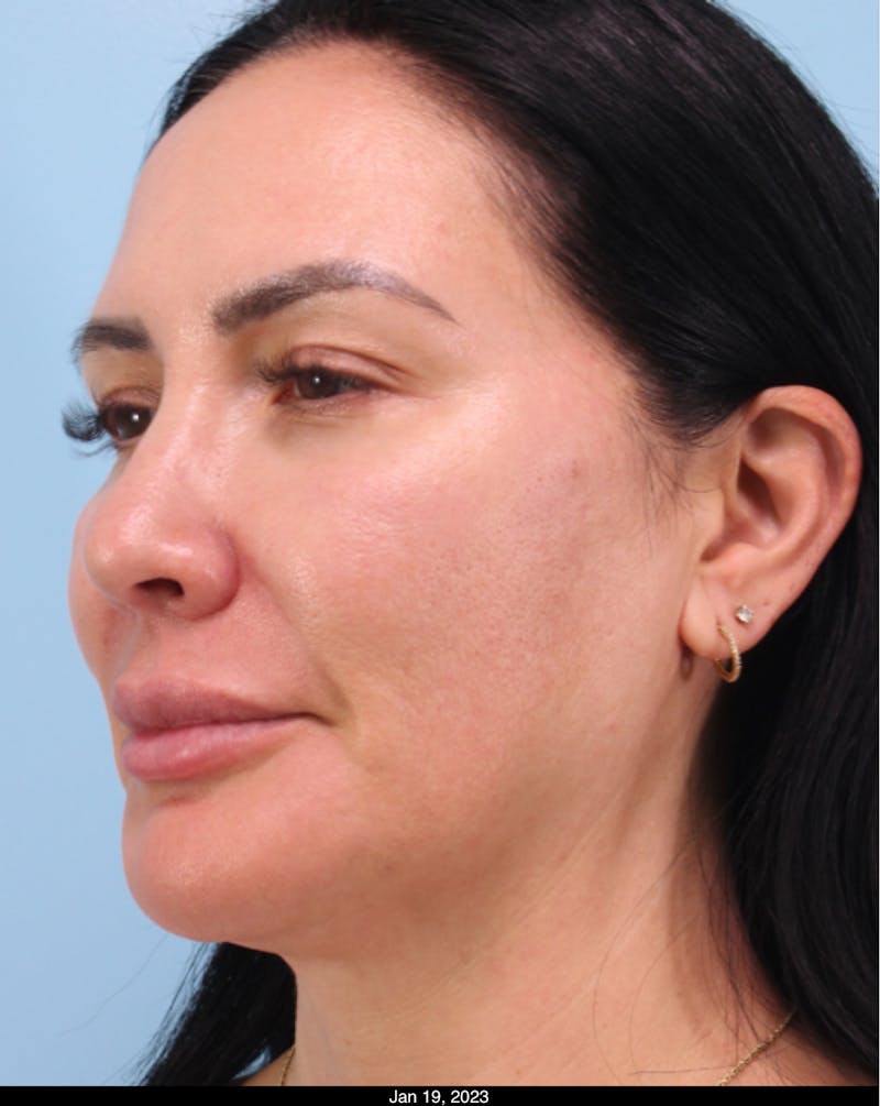 Dermal Fillers Before & After Gallery - Patient 385188 - Image 1