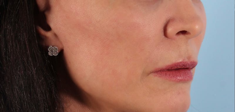 SKINVIVE Before & After Gallery - Patient 146005 - Image 3