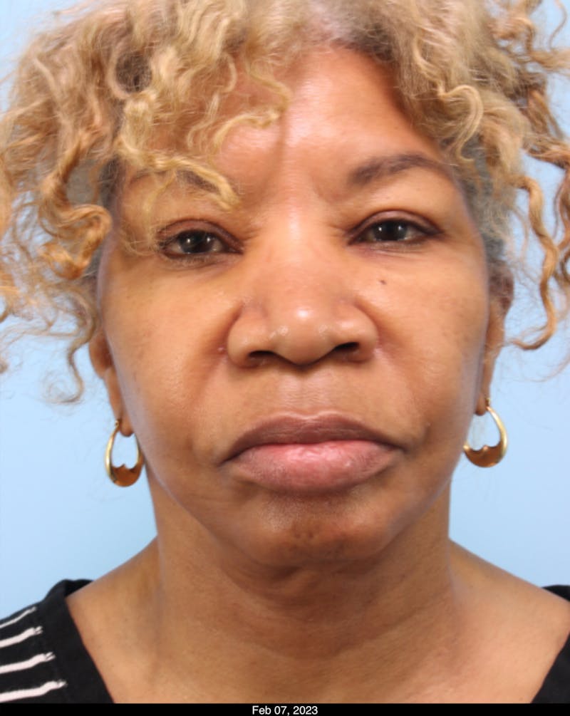Scarlet RF Microneedling Before & After Gallery - Patient 301252 - Image 3