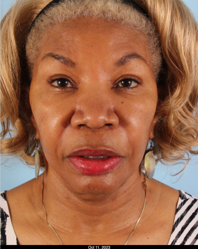 Scarlet RF Microneedling Before & After Gallery - Patient 301252 - Image 4