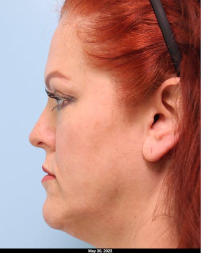 Scarlet RF Microneedling Before & After Gallery - Patient 307605 - Image 1