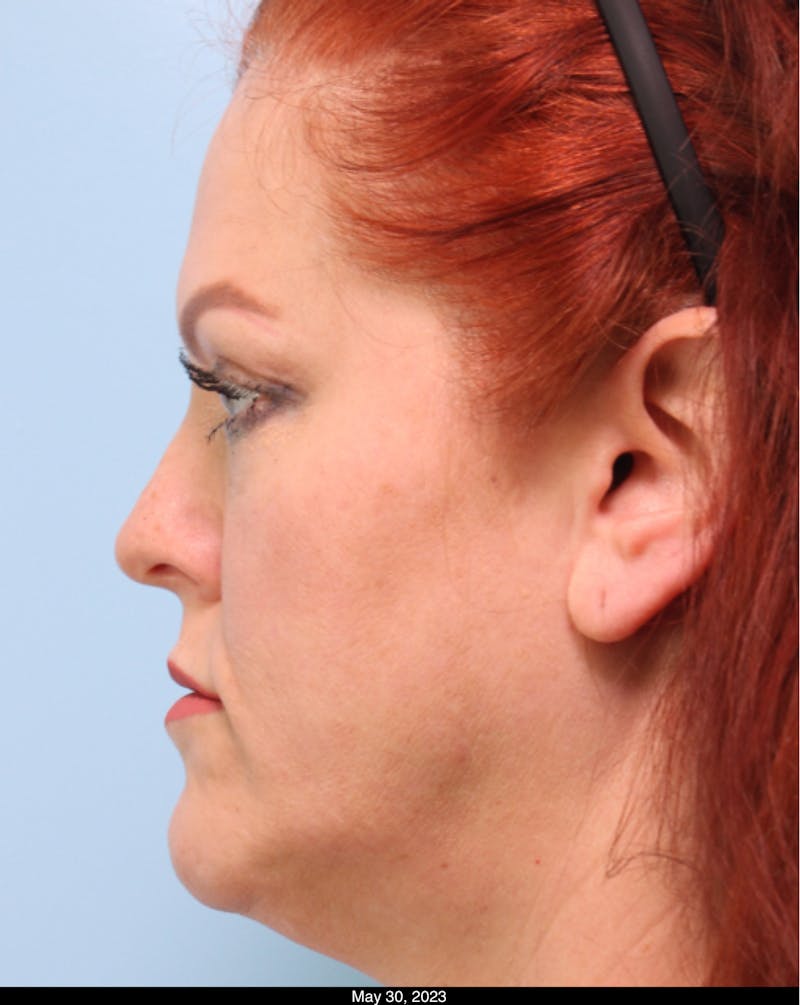 Scarlet RF Microneedling Before & After Gallery - Patient 307605 - Image 1