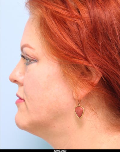 Scarlet RF Microneedling Before & After Gallery - Patient 307605 - Image 2