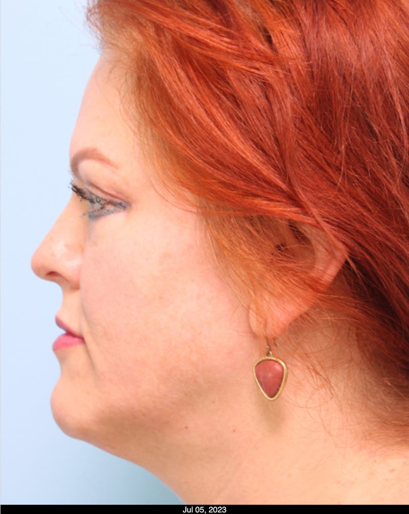 Scarlet RF Microneedling Before & After Gallery - Patient 307605 - Image 2