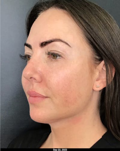 Thread Lift Before & After Gallery - Patient 262217 - Image 2