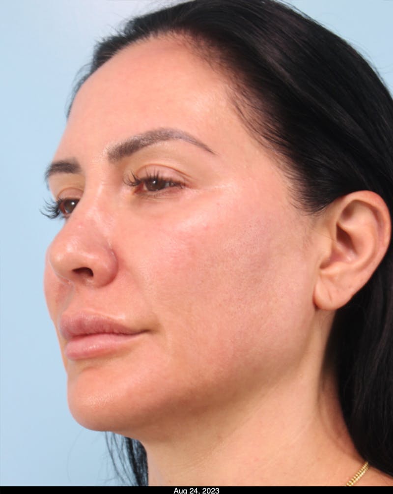 Thread Lift Before & After Gallery - Patient 199963 - Image 5