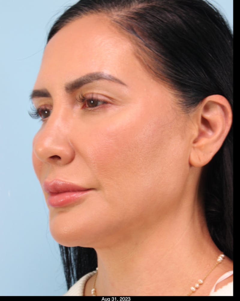Thread Lift Before & After Gallery - Patient 199963 - Image 6