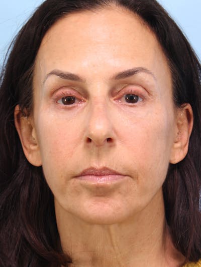 IPL Photofacial Before & After Gallery - Patient 500192 - Image 2