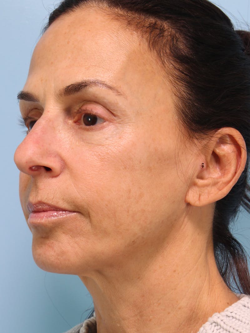 IPL Photofacial Before & After Gallery - Patient 500192 - Image 5