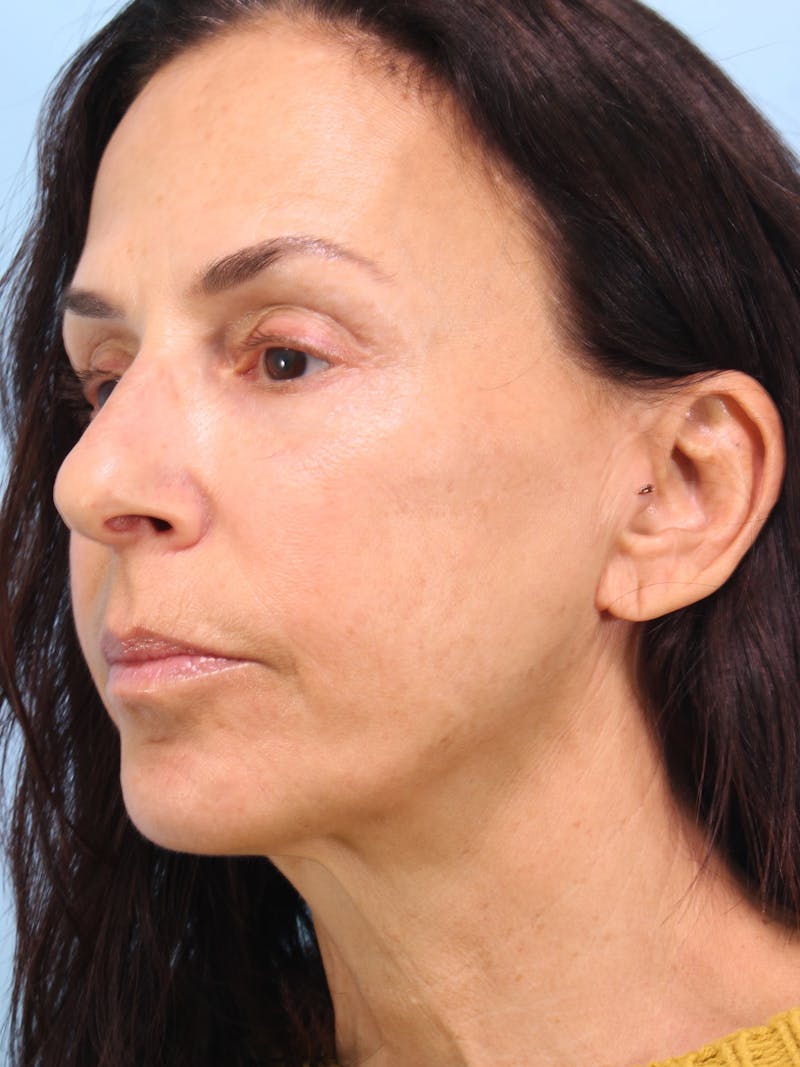 IPL Photofacial Before & After Gallery - Patient 500192 - Image 6