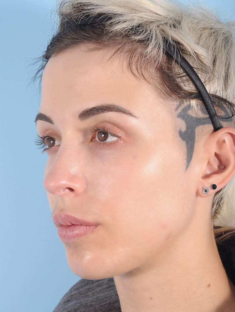 Forehead Reduction / Hairline Lowering Before & After Gallery - Patient 406757 - Image 3