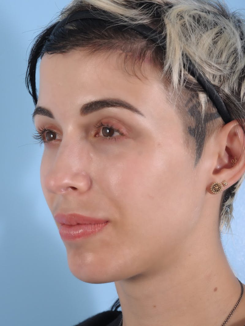 Forehead Reduction / Hairline Lowering Before & After Gallery - Patient 406757 - Image 4