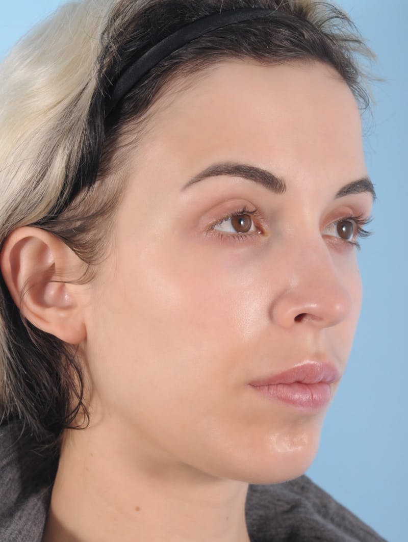 Forehead Reduction / Hairline Lowering Before & After Gallery - Patient 406757 - Image 5