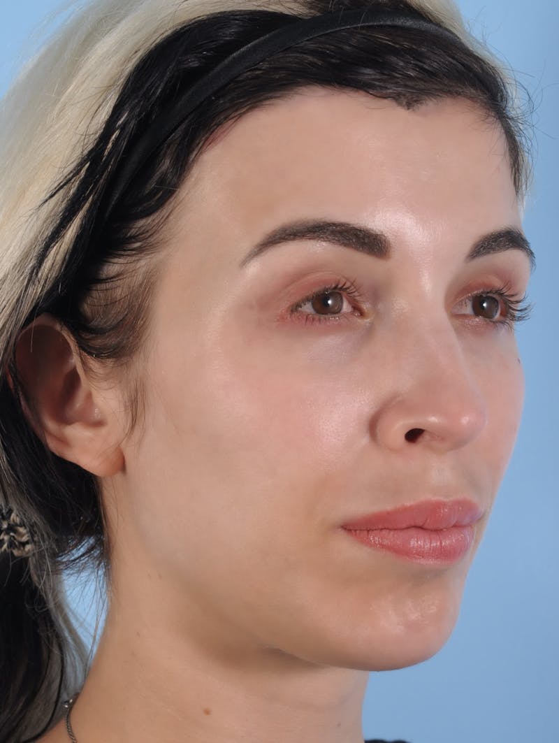 Forehead Reduction / Hairline Lowering Before & After Gallery - Patient 406757 - Image 6
