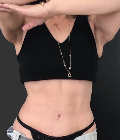 Semaglutide Weight Loss Before & After Gallery - Patient 250371 - Image 2