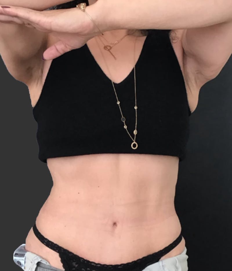 Semaglutide Weight Loss Before & After Gallery - Patient 250371 - Image 2