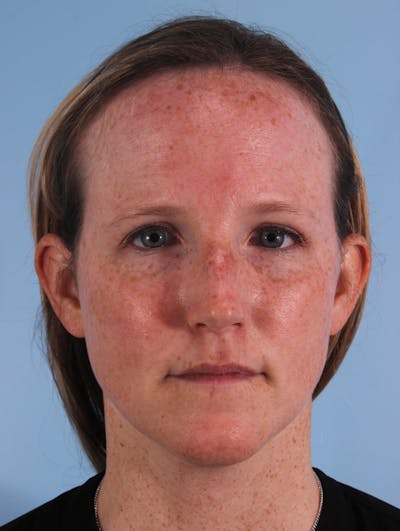 IPL Photofacial Before & After Gallery - Patient 420623 - Image 1