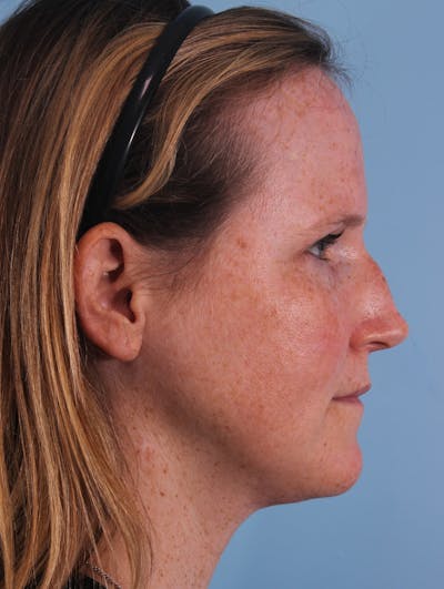 Rhinoplasty Before & After Gallery - Patient 391736 - Image 1