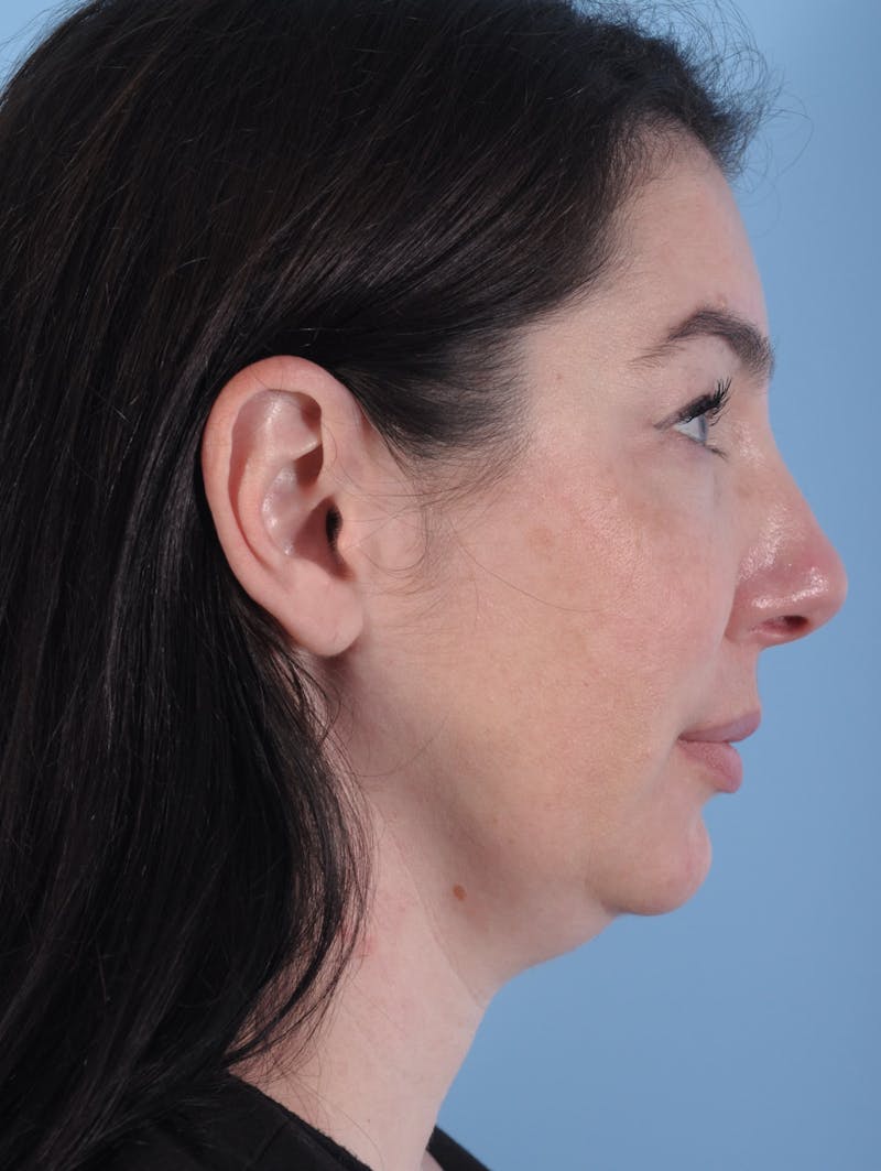 Coolsculpting Before & After Gallery - Patient 208005 - Image 1