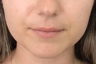 Dermal Fillers Before & After Gallery - Patient 237955 - Image 1