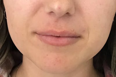 Dermal Fillers Before & After Gallery - Patient 237955 - Image 2